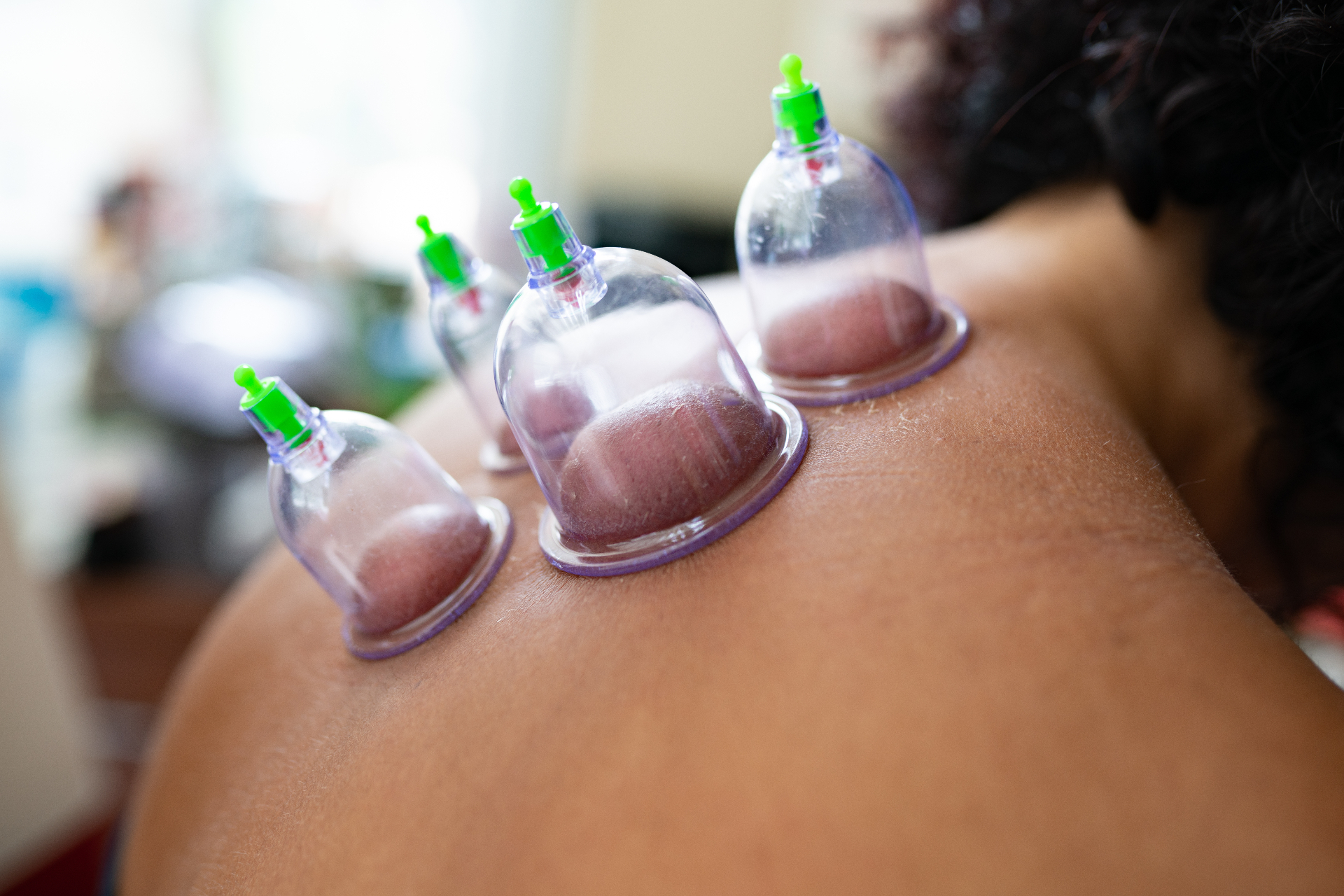 Cupping Therapy