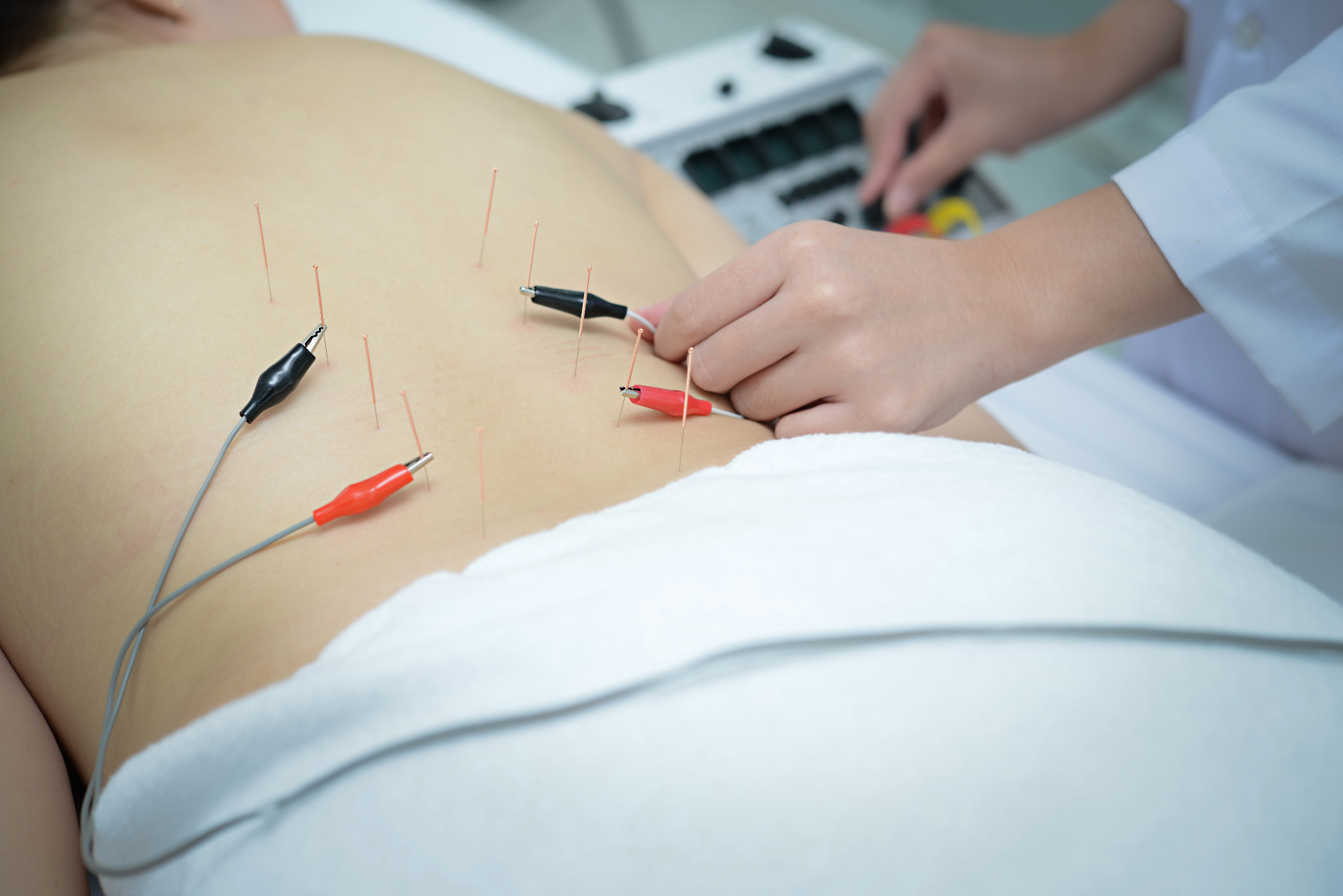 Dry Needling
